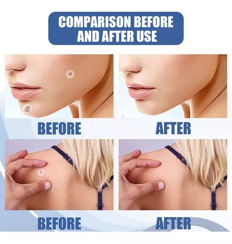 Miniatura 4 de SKIN TAG PARCHE